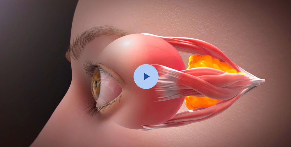 Understanding TED and Graves Disease